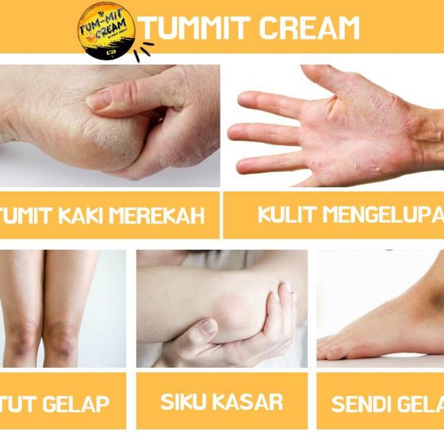 Krim Untuk Tumit Kaki Pecah Shopee Malaysia