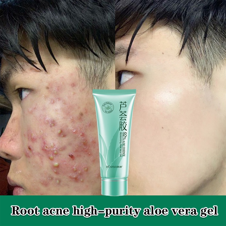9.9 3pcs RM3.99 Aloe vera gel aftersun repair cream 40g to remove acne