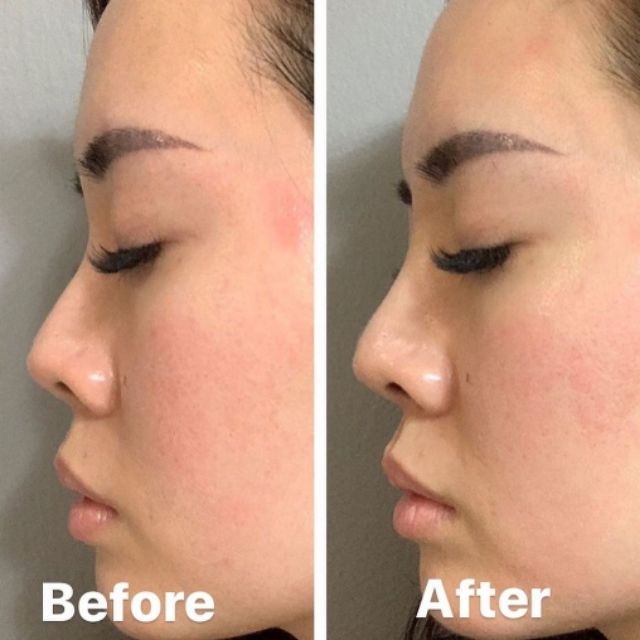 Kursus Tanam Benang Hidung Shopee Malaysia