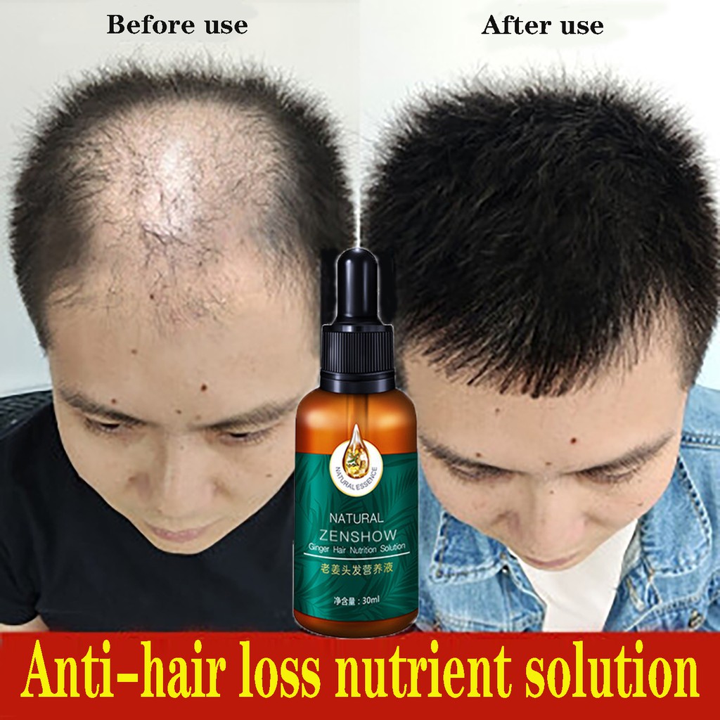 Hair growth essence Hair tonic for hair growth 30ml Anti hair fall serum  Repair hair roots and treat hair loss | Shopee Malaysia