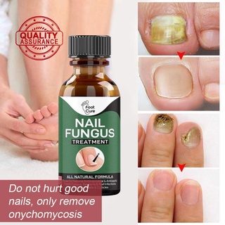 Nail Repair Liquid Hand and Foot Onychomycosis Care Liquid Repair Antibacterial Nails U1T3