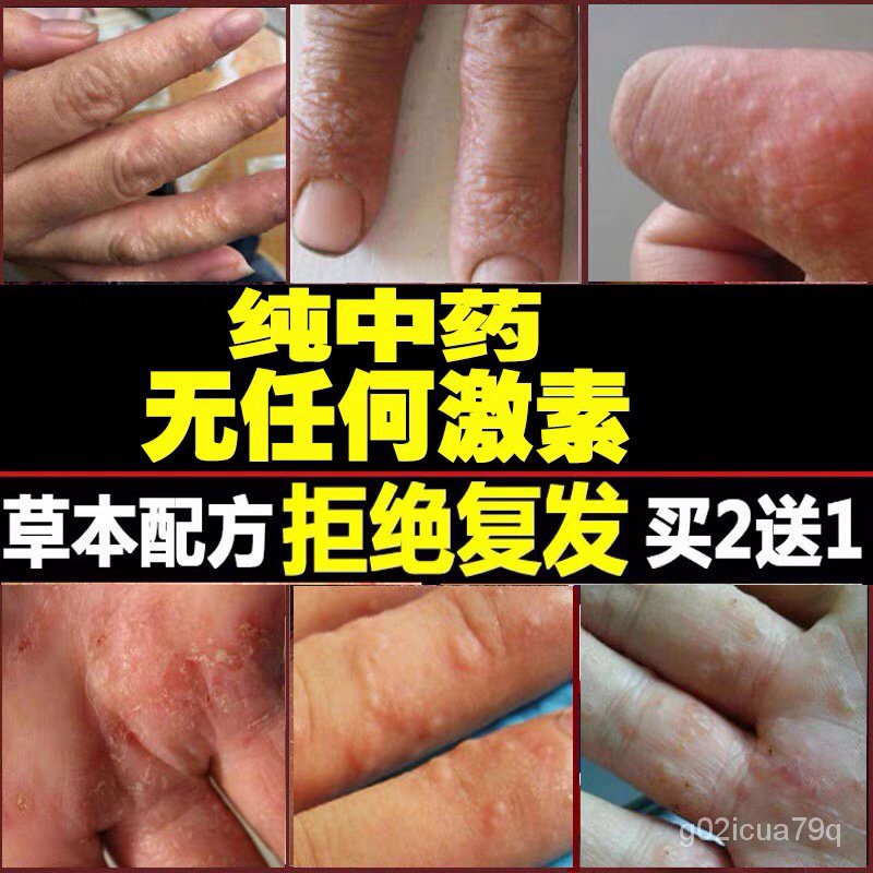 皮肤药手上痒指起小水泡汗疹手气止痒脱皮杀菌皮肤瘙痒过敏药黄金百草膏 Shopee Malaysia