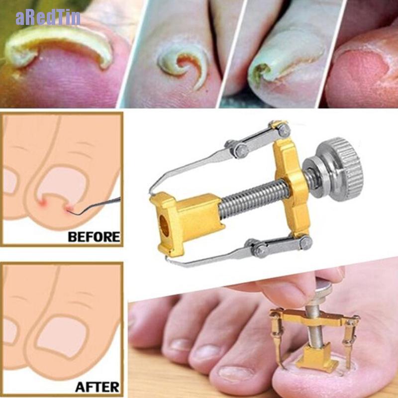 aRedTin Ingrown Toenail Toe Fixer Recover Correction Device Pedicure