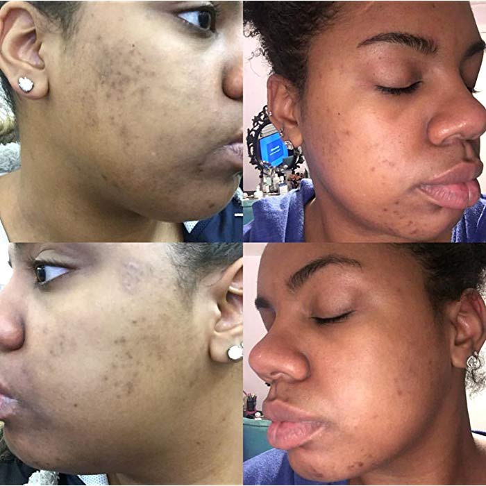 admire my skin 2 hydroquinone