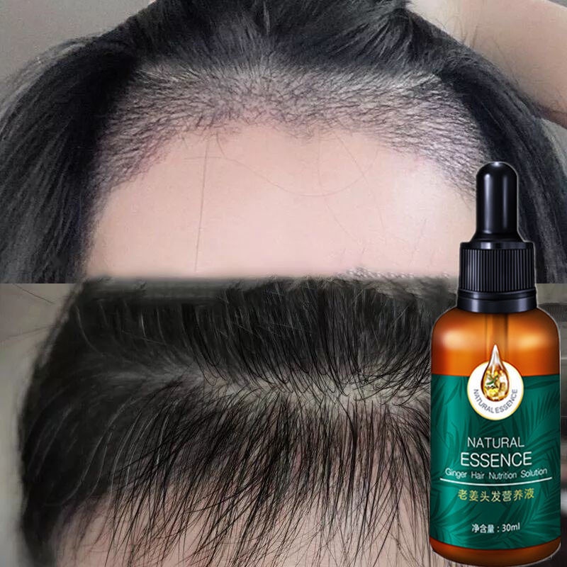 Hair Growth Conditioner, Herbal Ginger Essence Nutrient Fluid Essence, Hair  Oil Essence for Hair Loss Treatment | Shopee Malaysia