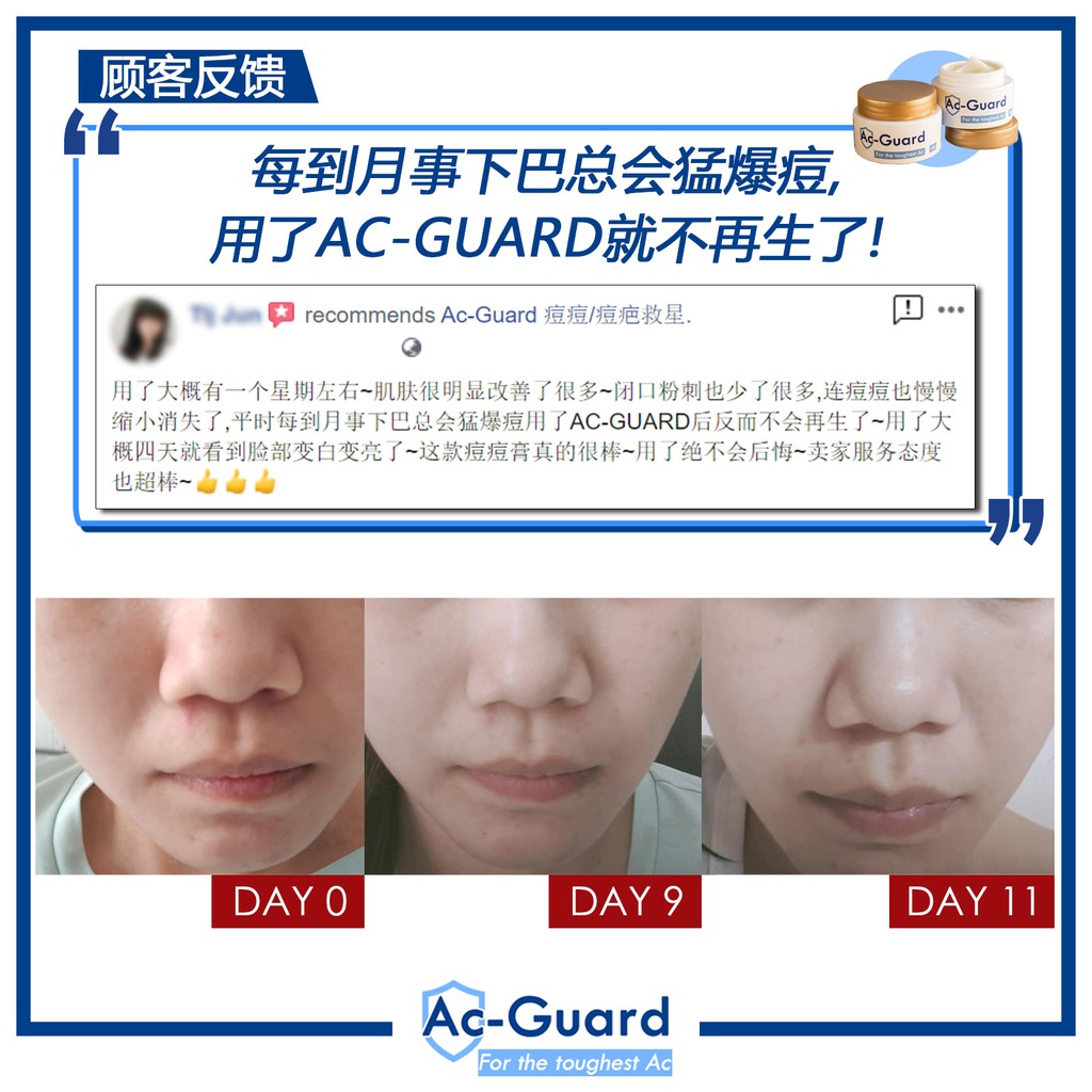 ac guard acne