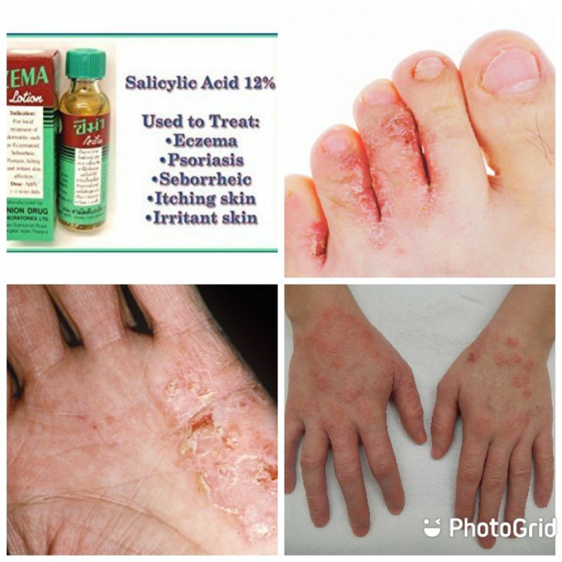 salicylic acid eczema