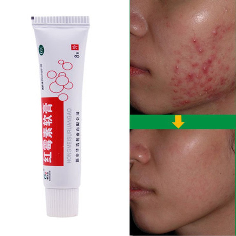erythromycin acne cream