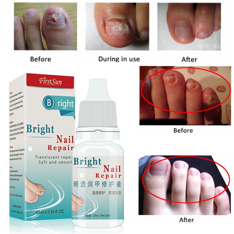 Kills 99 9 Bacteria And Fungus Nail Fungus Treatment Cream Shopee Malaysia