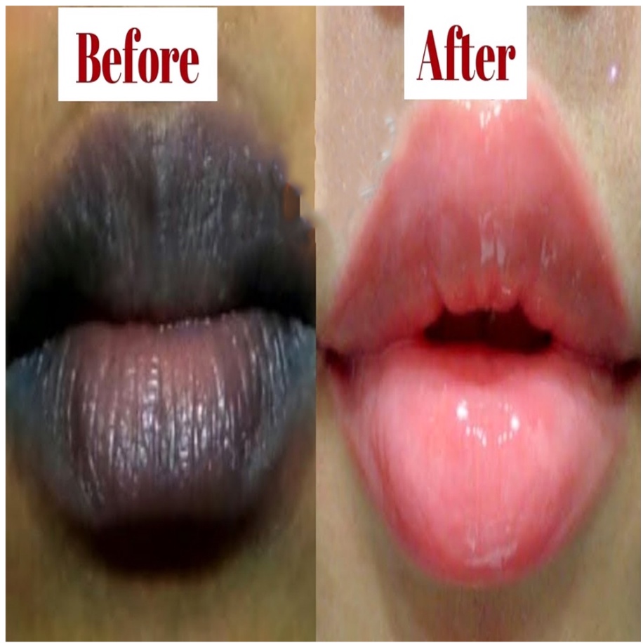 Lighten Dark Lips Naturally With Just Two Ingredients, 49 OFF