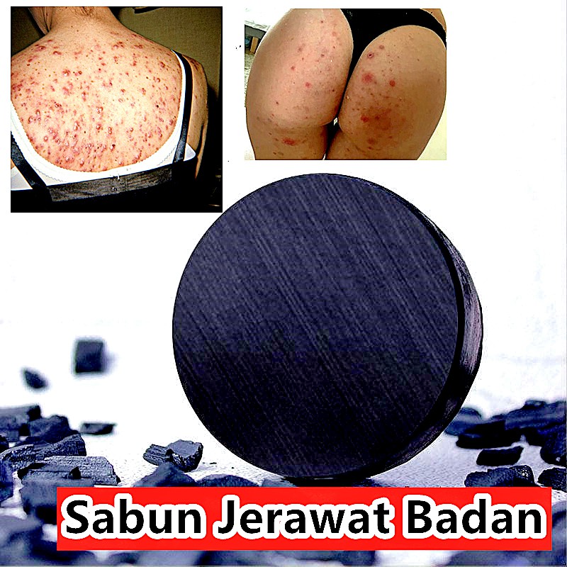 Sabun Jerawat Badan dan Muka 80gram charcoal salicylic acid buang daki