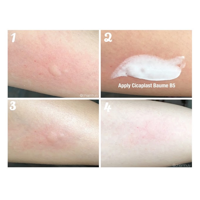 la roche posay cicaplast acne