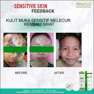 Ubat  Serum Ekzema, Psoriasis, Masalah Kulit sensitif, Lotion Eczema