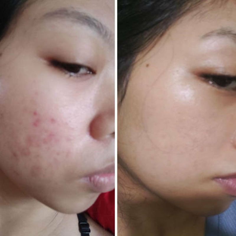 Ubat Untuk Jerawat Acne Pills Green 10 S Jerawat Batu Acne Breakouts Jerawat Muka Jerawat Hilang Ubat Jerawat Shopee Malaysia