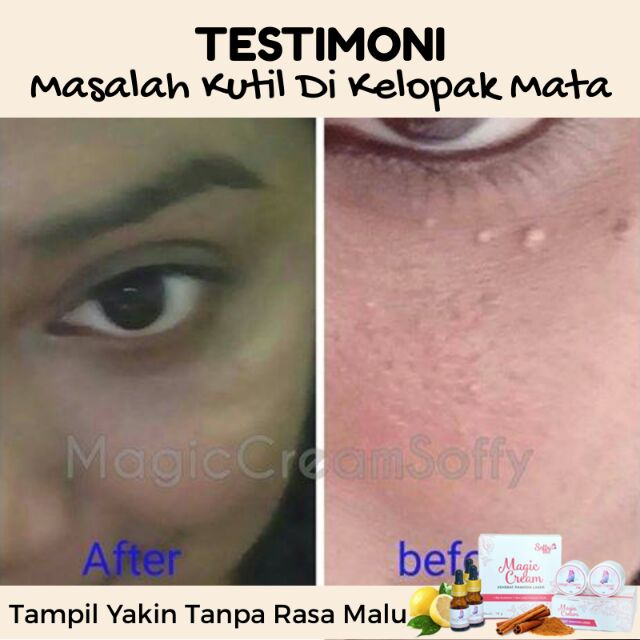 Ketuat di muka