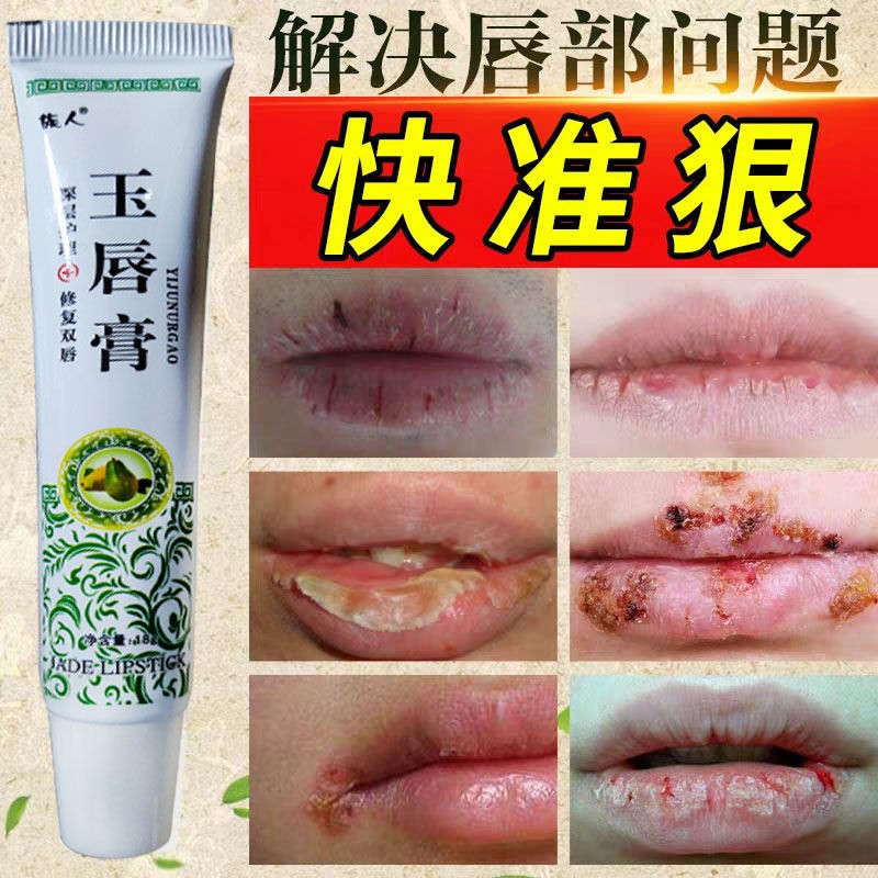 Buy 唇炎膏润唇膏唇炎膏 后悔没早买 润唇膏修复嘴唇干裂起皮唇周炎过敏性唇炎 Seetracker Malaysia