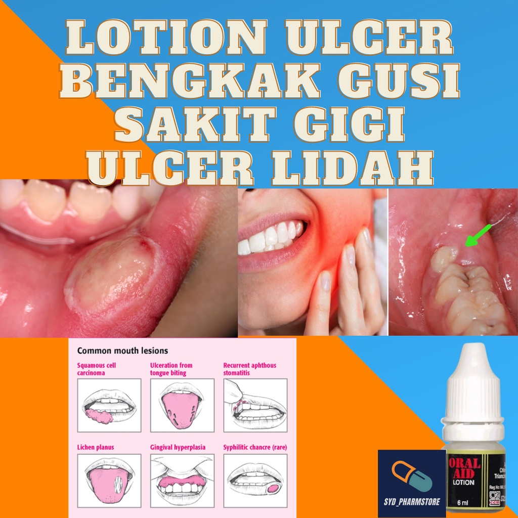 Oral Aid Lotion 6ml Ulcer Bengkak Gusi Sakit Gigi Shopee Malaysia