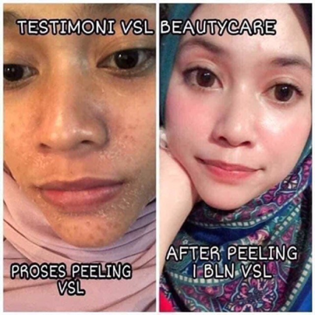 Vsl Jualan Sambut Lebaran Set Normal Proses Peeling 14 Hari Untuk Kulit Kusam Jeragat Dan Bintik Hitam Bintik Hi Shopee Malaysia