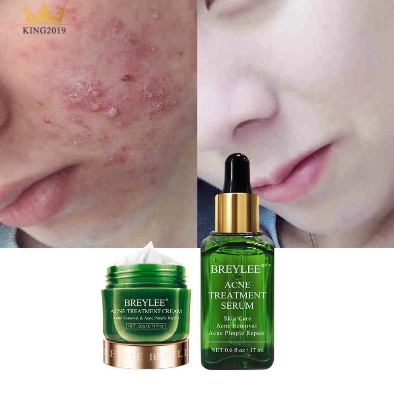 breylee acne treatment kit