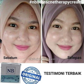 nb acne scar cream