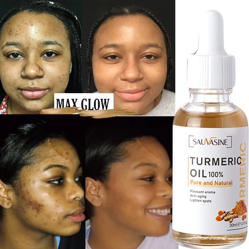 Turmeric Lemon Oil Skin Glow To Lightening Acne Dark Patches, Acne ...