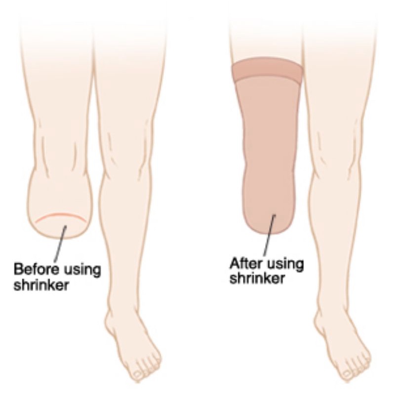 Stokin Kaki Kudung/ Stump Shrinker Amputation / Easy Stump Bandage for ...