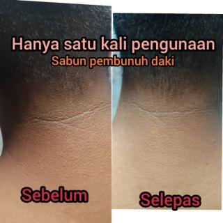 SABUN PEMBUNUH DAKI ( kegunaan seluruh muka & badan 