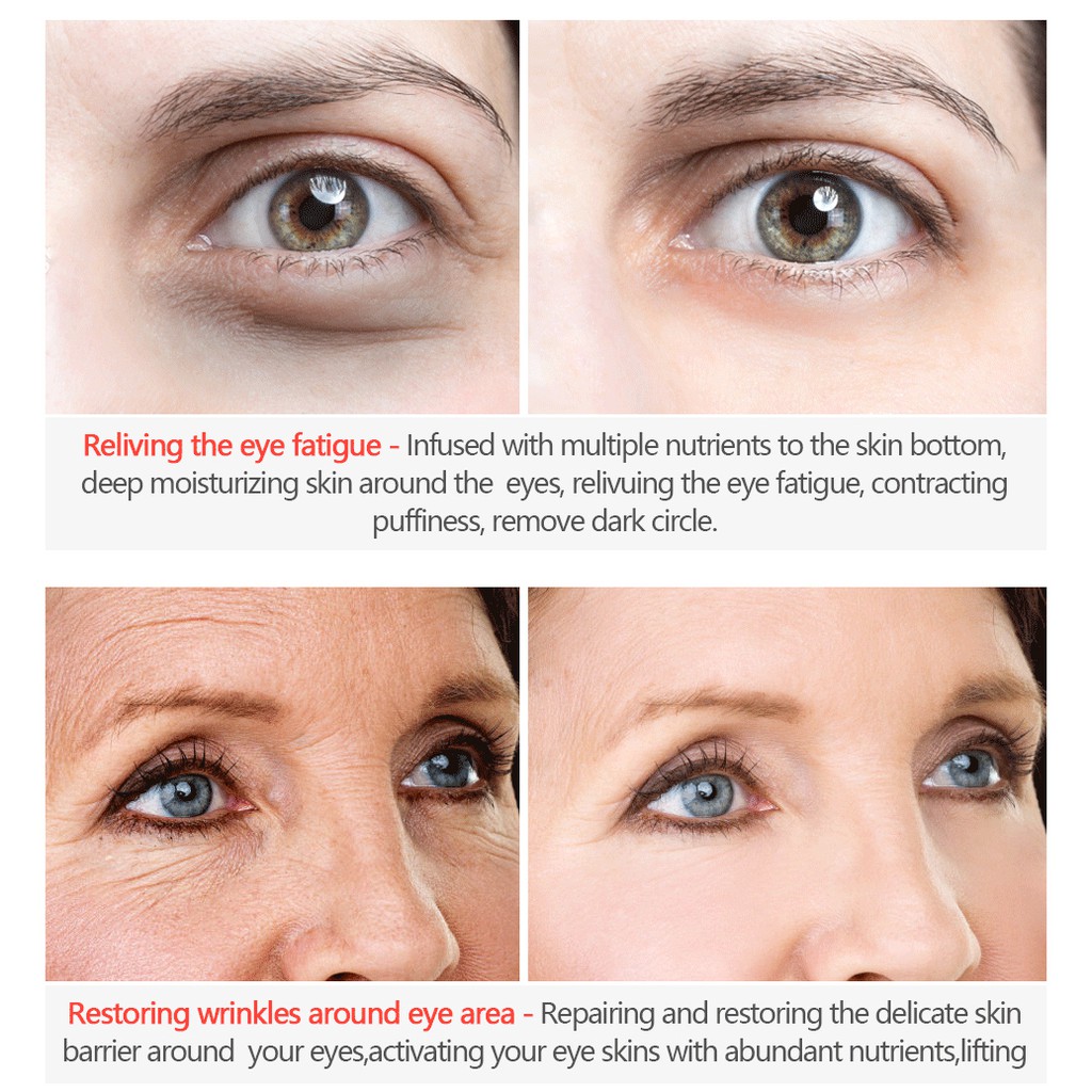 wrinkles around my eyes