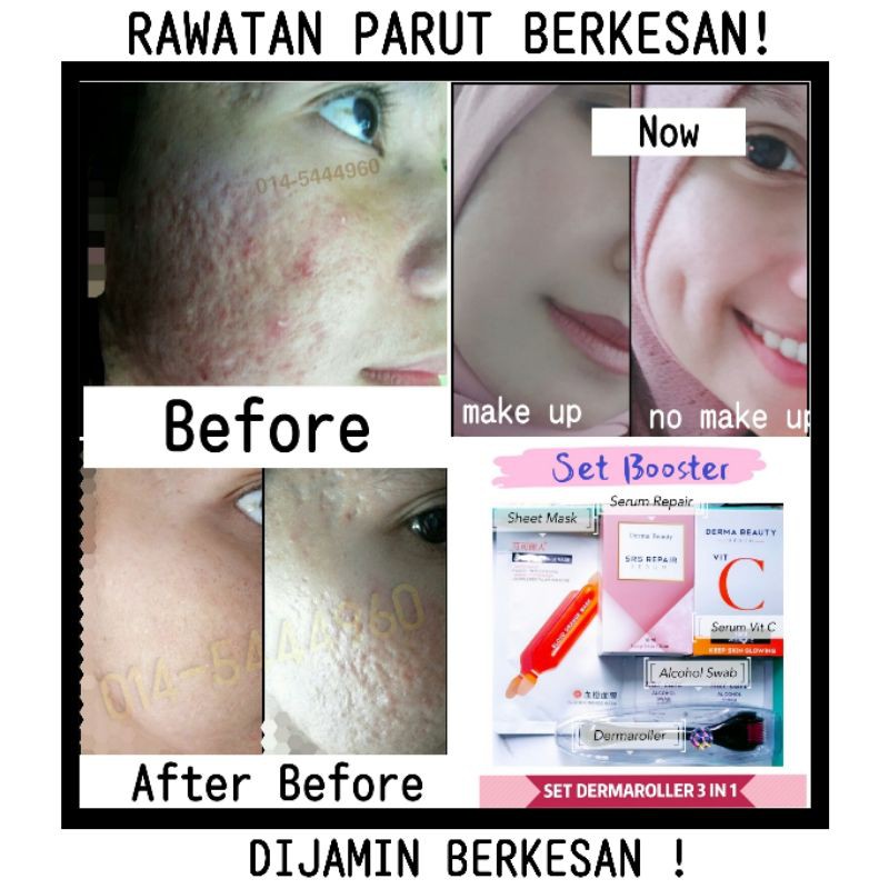 Microneedle Parut Jerawat Set Dermaroller High Quality Parut Berlubang Serum Parut Pori Terbuka Deep Scar Acne Serum Sc Shopee Malaysia