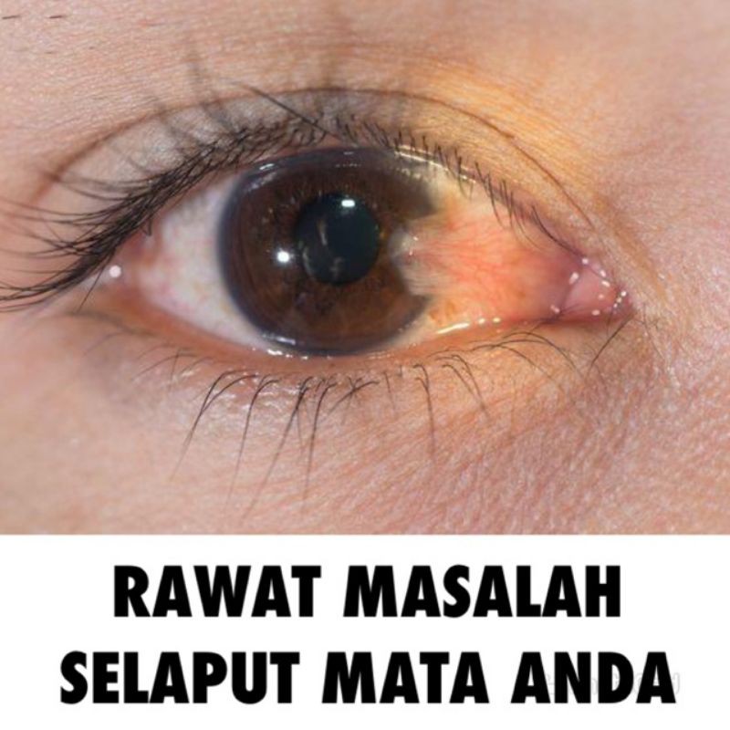 Cara Merawat Mata Merah