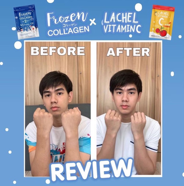 Combo Set Lachel Vitamin C Frozen Collagen Shopee Malaysia