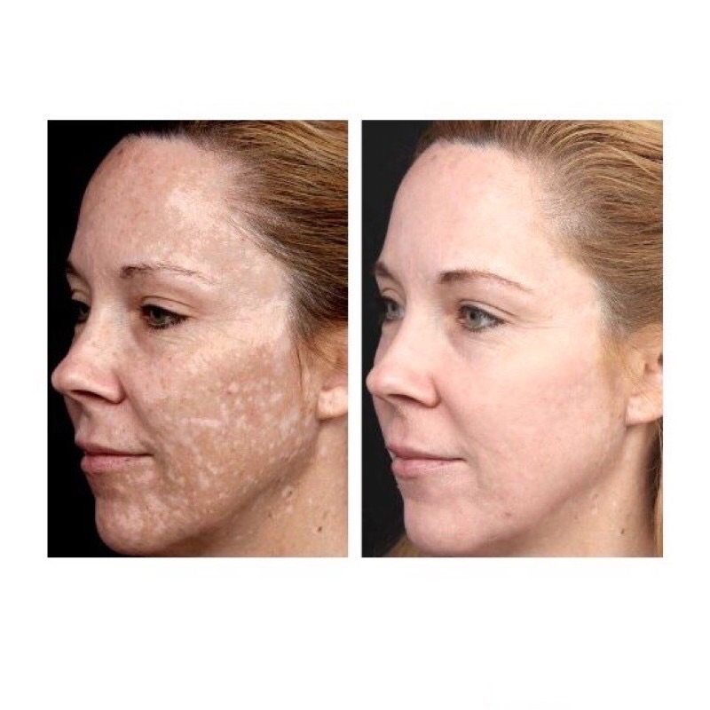 Hydroquinone Cream Before And After