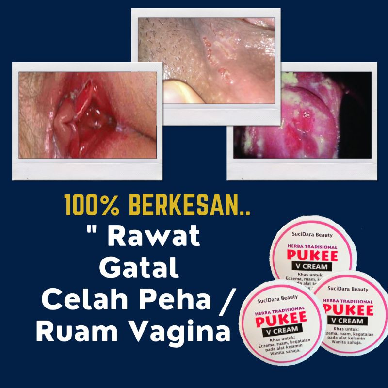 Krim Ubat Herbal Hilang Gatal Miss V Gatal Kemaluan Wanita Ubat Gatal Kulit Kemaluan Gatal Celah Peha