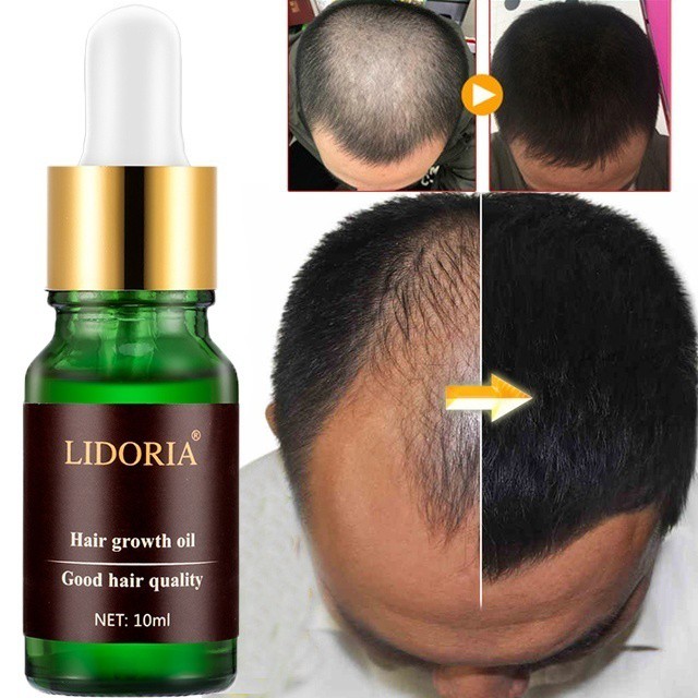 100 Original 10ml Hair Loss Products Natural With No Side Effects