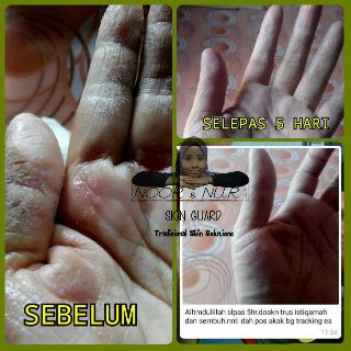 UBAT KUDIS / scabies, KAYAP, RUAM / rash, EKZEMA / eczema 