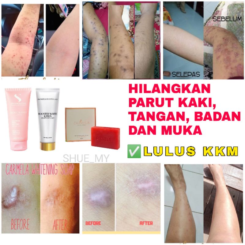 Hilangkan Parut Kaki Parut Tangan Parut Badan Parut Hitam Parut Kudis Kulit Gatal Pudarkan Strechmarkbody Ca Shopee Malaysia