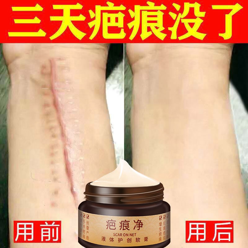Scar-removing cream, scar-repairing, no scars, re-ping, scar-removing ...