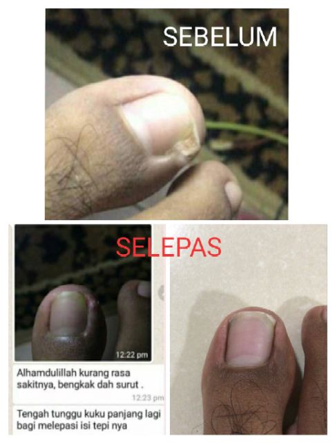 Stresnya Bila Kena Fahamkan 7 Perkara Tentang Cagu Aka Cengkam Kuku