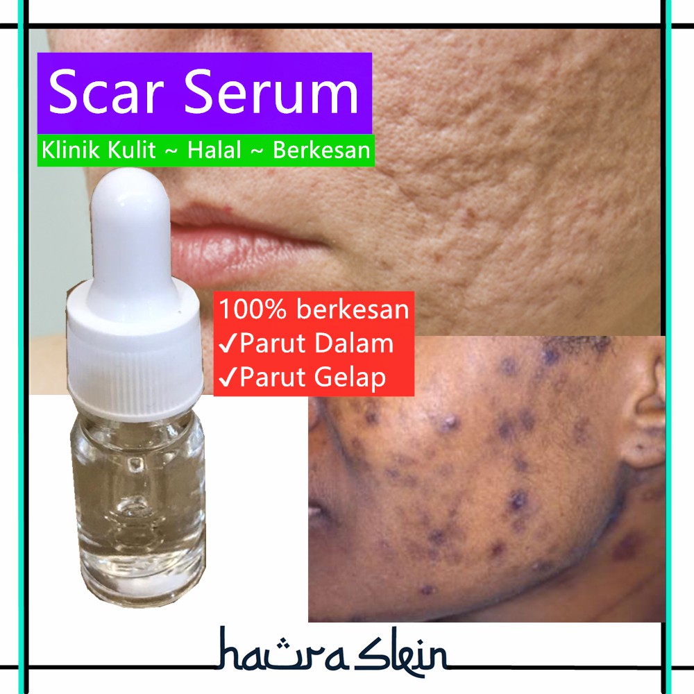 Untuk jerawat serum parut 6 Produk