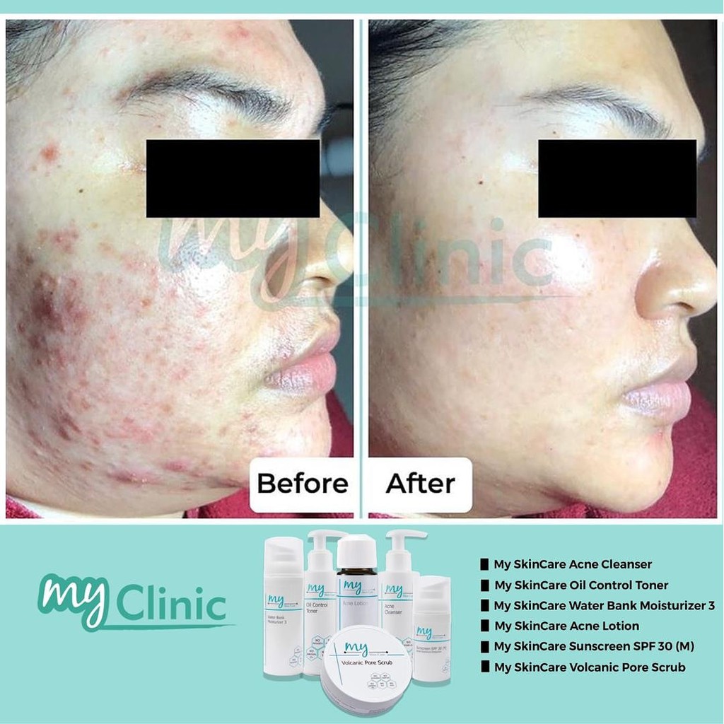 myclinic acne cleanser