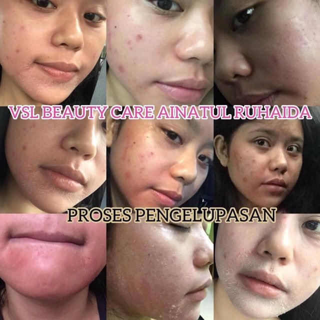 Buy Vsl Skincare Set Normal Acne Seetracker Malaysia