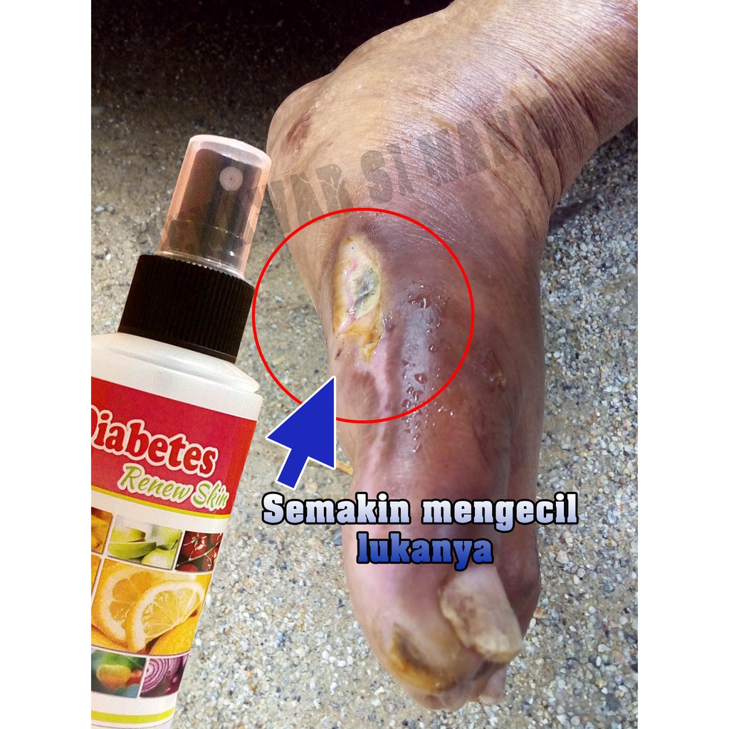 AzfaRich Penawar Luka Kencing Manis - Diabetes Renew Skin 