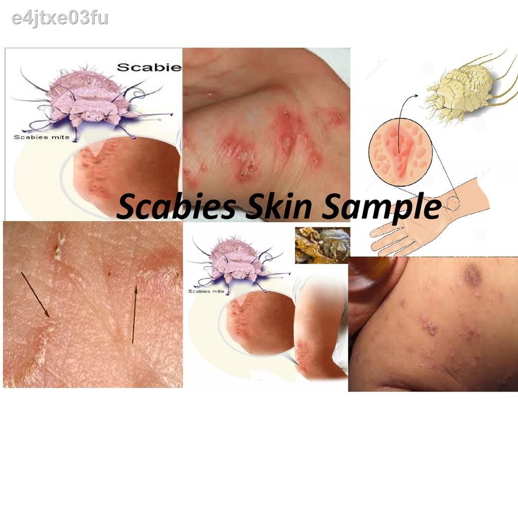 Permethrin Ubat Kutu Kudis Buta Scabies Dan Semua Jenis Kutu Manusia Shopee Malaysia