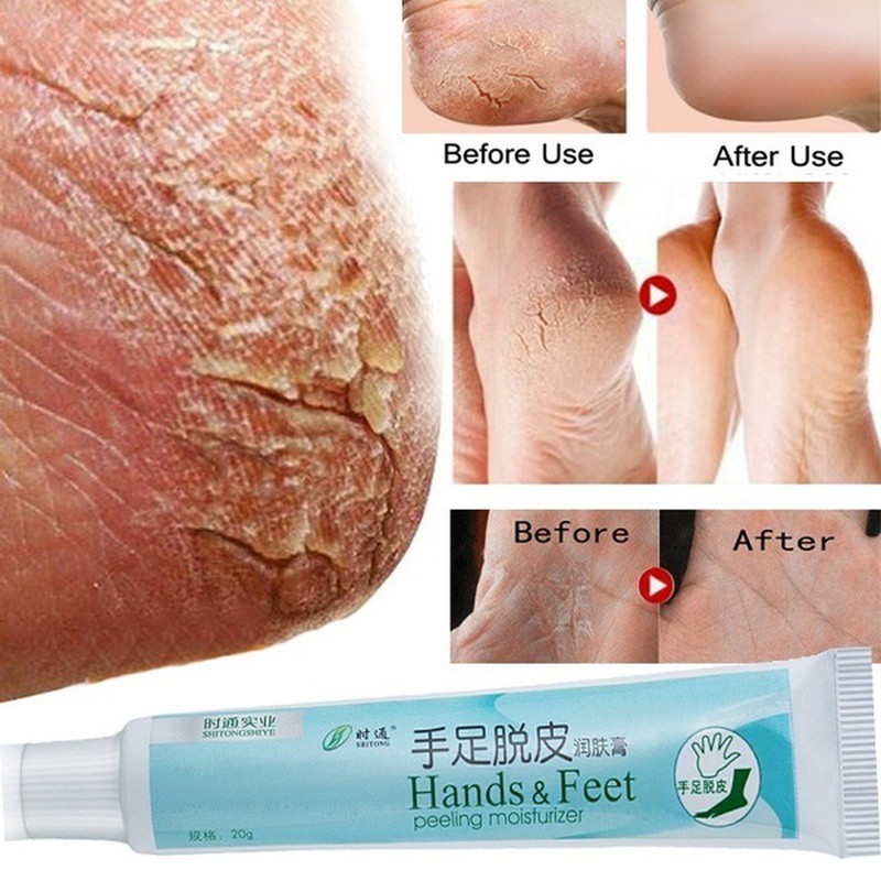 Natural Cream Skin Cracked Heel Cream Essence Suitable For Rough Dry Cracked Hand Heel Peeling Dry And Feet Body Cream Shopee Malaysia