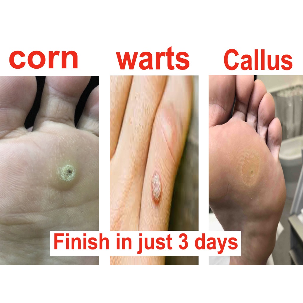 Warts, Corns & Calluses treatment in 3 days only 100 orignal Imported Product Shopee Malaysia