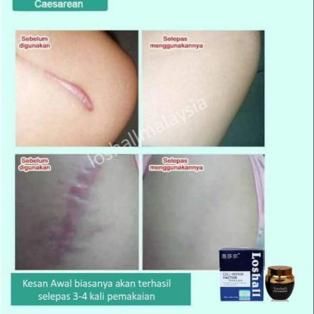 Krim Hilangkan Parut Shopee Malaysia