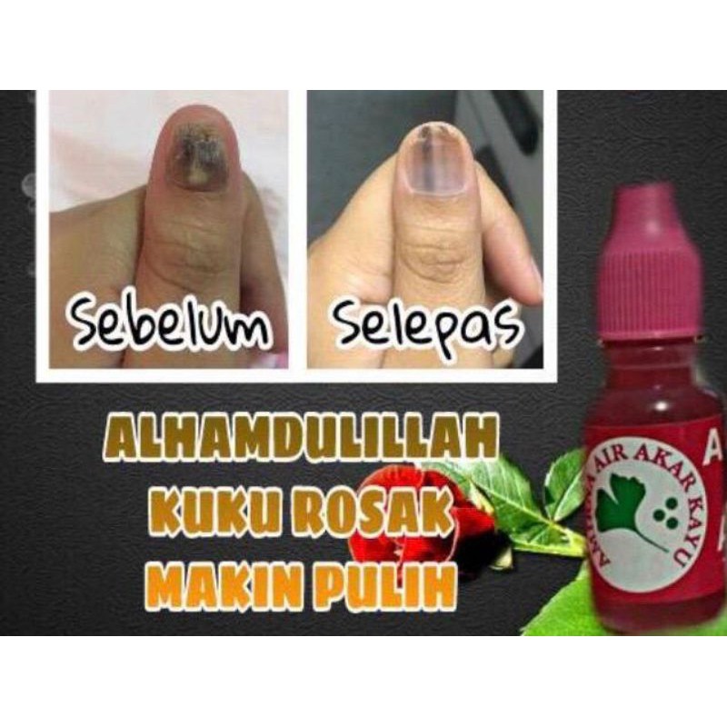 Amirna Original Kkm Air Akar Kayu Ubat Cagu Cengkam Kuku Panau Kulat Air Kurap Ubat Luka Kencing Manis Shopee Malaysia