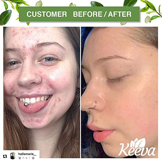 keeva acne scar cream