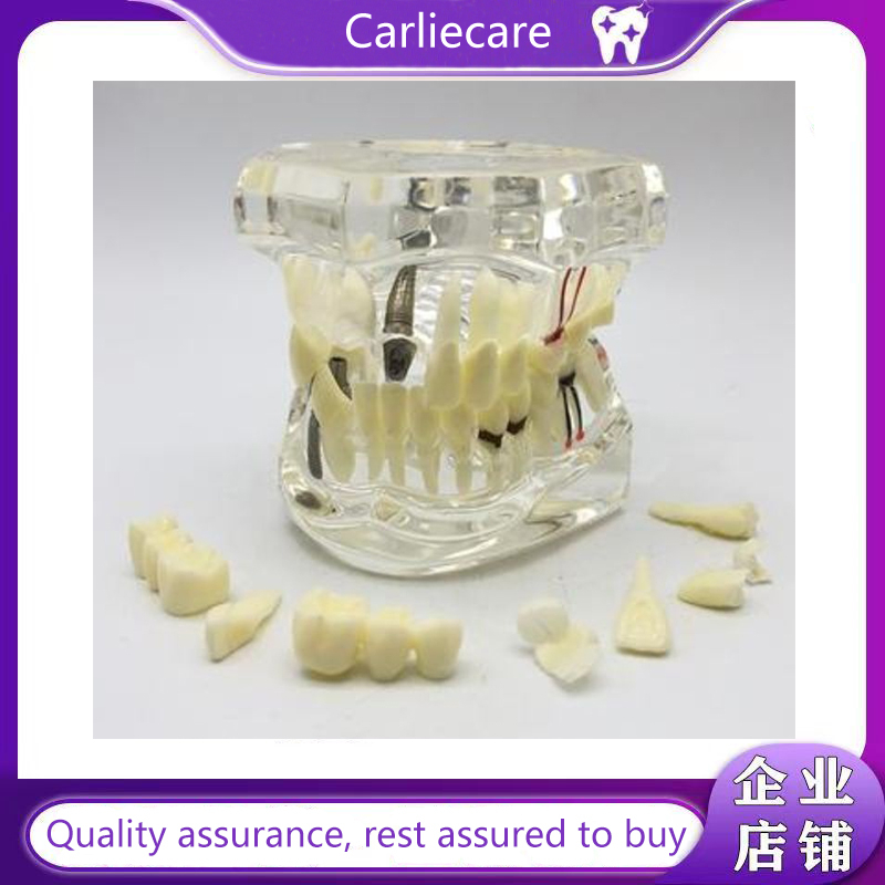 Dental Restorative Model Transparent Dentist Removable Pathological Implant Oral model 模型