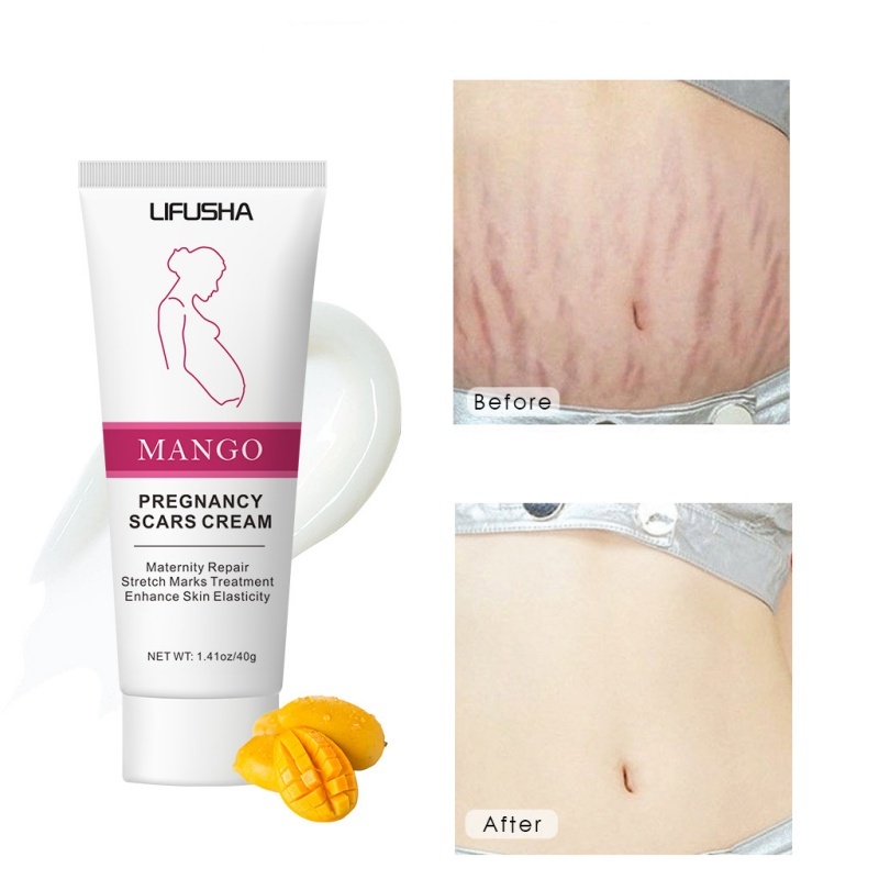 Mama's Choice Stretch Mark Treatment Series | STRETCH MARK CREAM  (Safe, Halal, Natural Maternity Skincare)